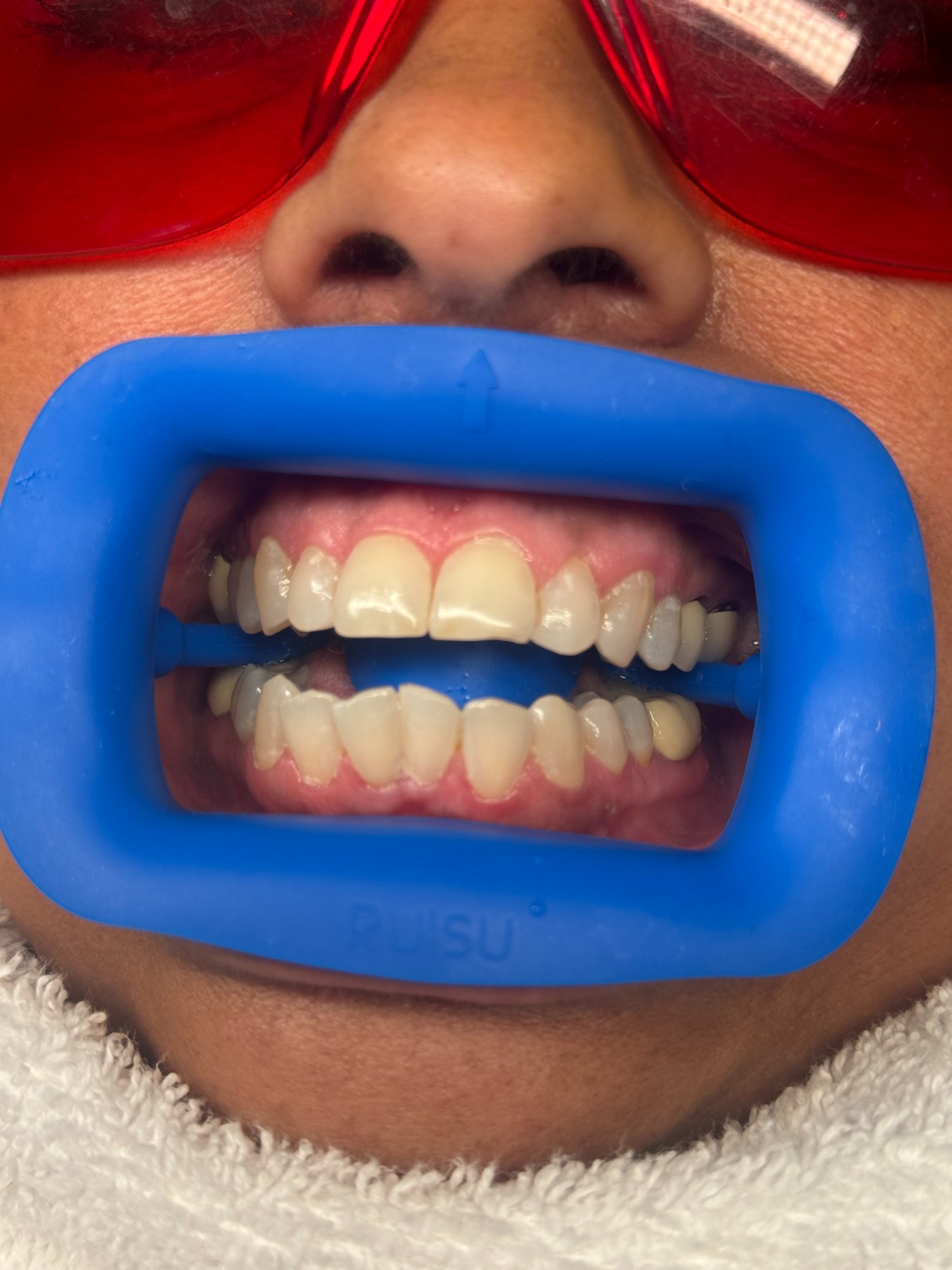 teeth whitening before and after - The Bronze Lily St. Petersburg, FL