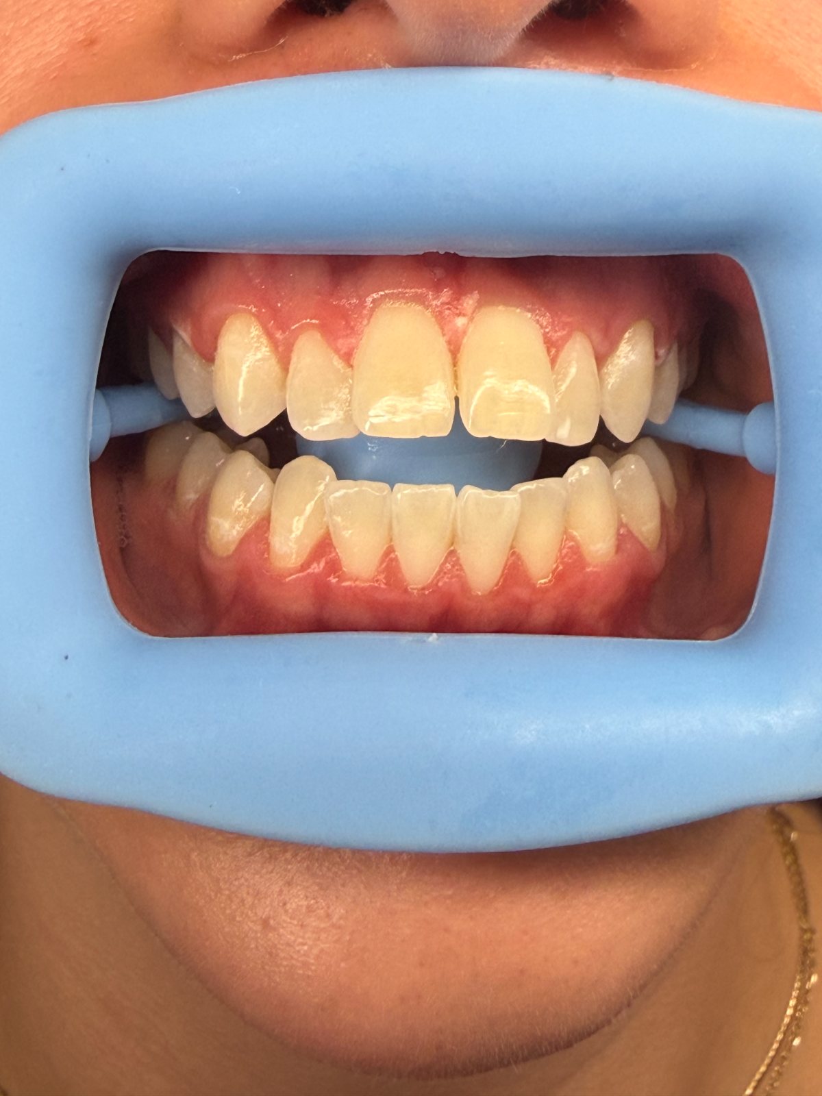 6 Shades Whiter in 1 Full Teeth Whitening Treatment