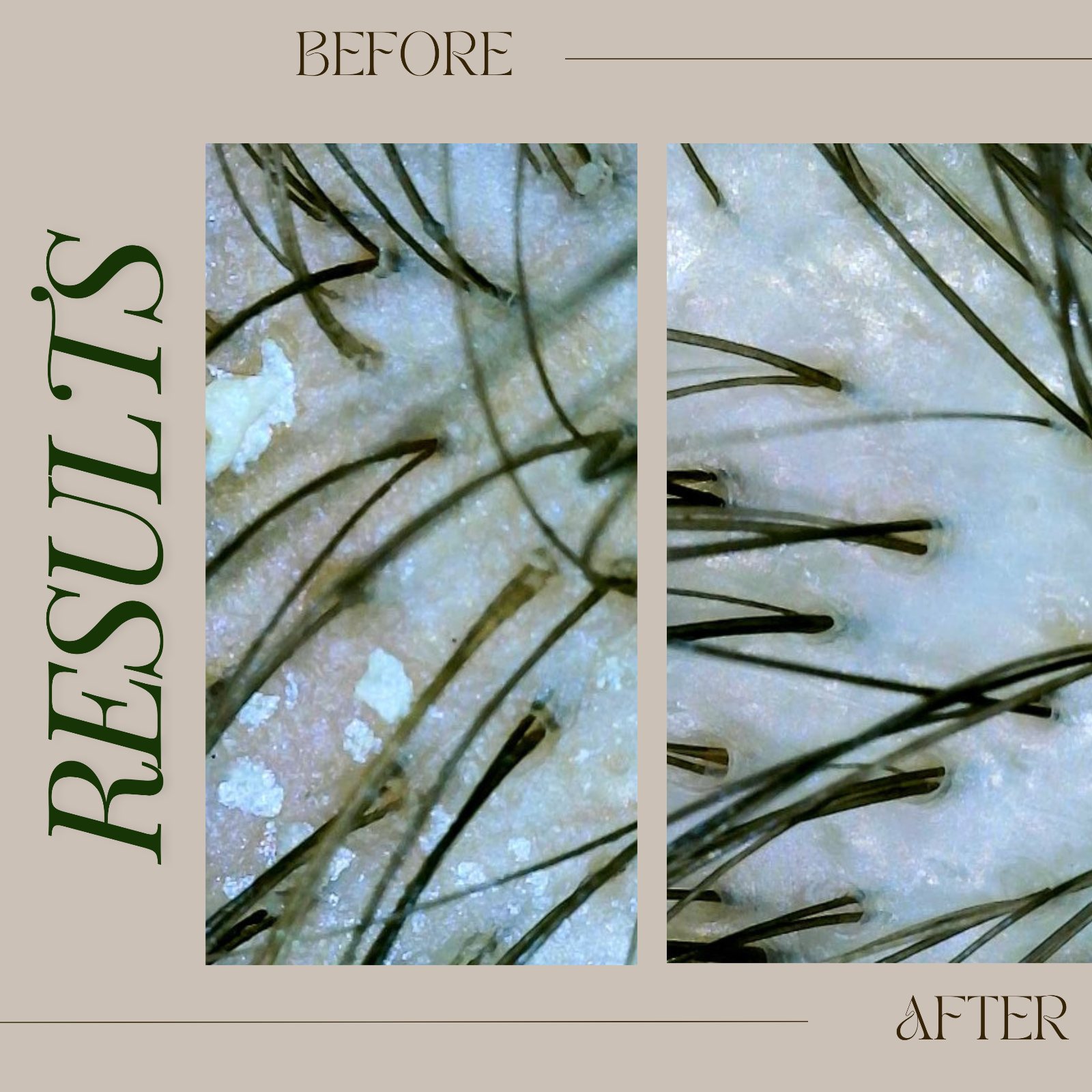 Tricho results, before & after composite 4 — The Bronze Lily, St. Petersburg, FL